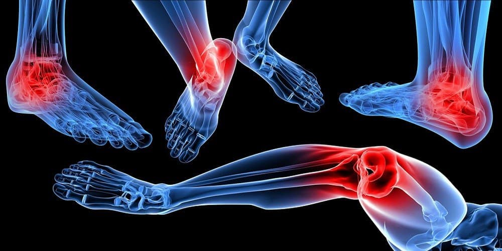 ROMATİZMAL ATEŞ VEYA AKUT EKLEM ROMATİZMASI HASTALIĞI