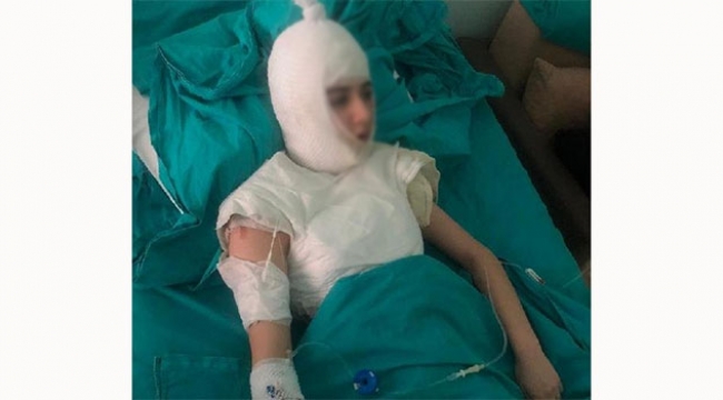 Üvey anne dehşet saçtı üvey kızını haşladı