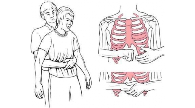 Heimlich manevrası nedir?