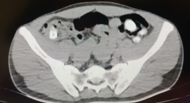 Midesinden uyuşturucu çıktı!