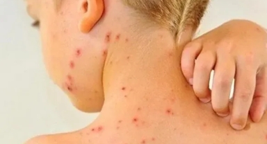 Kızamık Vakalarında Korkutan Artış! 40 Bin Kişi...