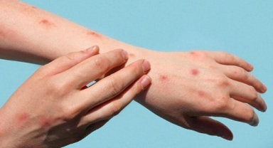 Maymun Çiçeği Virüsü Pandemi Etkisi Yaratır Mı?