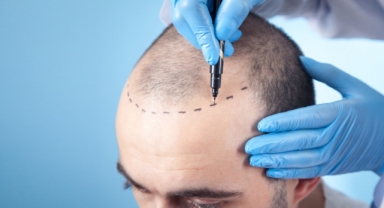 Doğru Saç Ekimi İle Hayalinizdeki Saçlara Kavuşun