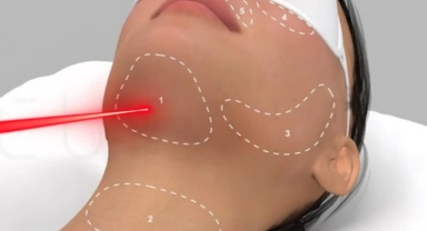Endolift Lazer