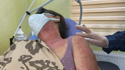 Beyazlatıcı Krem Faciası:4 Kişi Hastanelik Oldu
