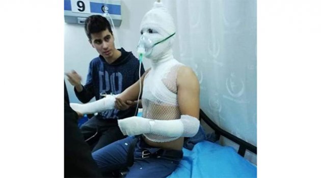 Evde deney yapan lise öğrencisi kendini yaktı