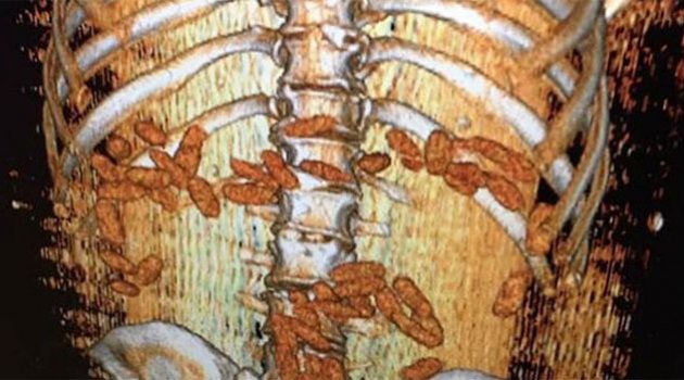 Faslı midesinden 120 kapsül içinde 640 gram esrar çıktı