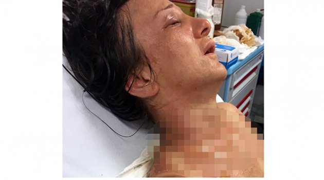 Kaynananın gelinini kızgın yağ ile yaktığı iddiası