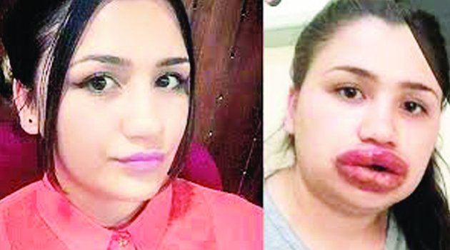 Sahte estetikçiye ‘dudak dolgusuyla yaralama’ davası