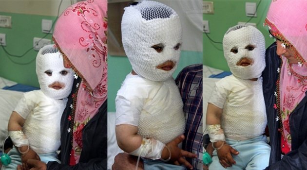 Süt kazanına düşen çocuk feci şekilde yandı