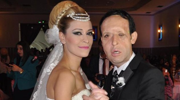 Yüz nakli olan Recep Sert, baba olmaya hazırlanıyor