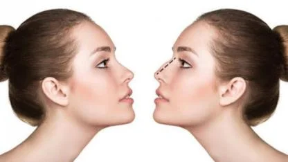 Burun Estetiği Nefes Almak İçin Önemli