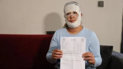 Prenses Cilt Bakımı Kabusa Döndü:Yüzünde Yanıklarla Geri Döndü!