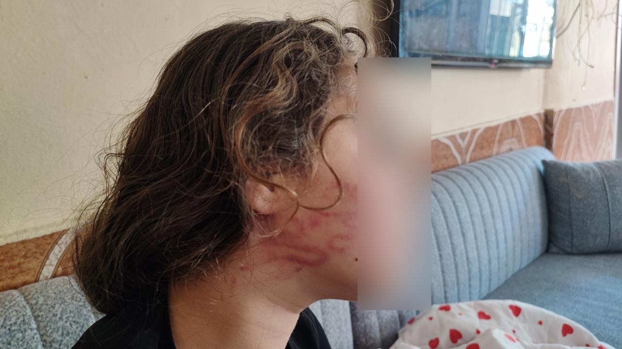 Epilepsi Hastası Çocuğa Şiddet İddiası:Yüzü Şişti, Dişleri Kırıldı